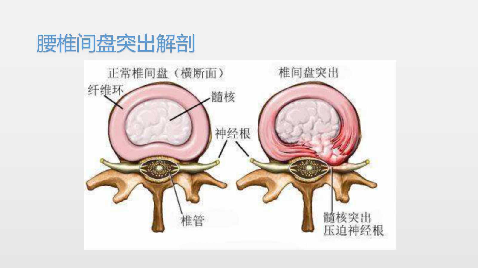 特雷-曼腰椎间盘突出伤病完全恢复，已参加对抗训练的简单介绍